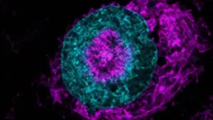 Immagine al microscopio di una cellula tumorale evidenziata con colorazione fluorescente