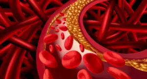 Simulazione di un'arteria ostruita da depositi di grasso e globuli rossi